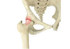 Femoro Acetabular Impingement