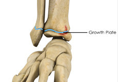 Growth Plate Fracture