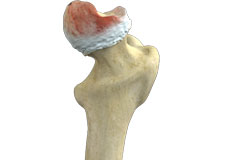 Hip Osteonecrosis