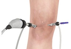 Knee arthroscopy