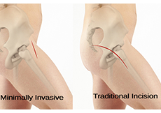 Minimally Invasive Total Hip Replacement