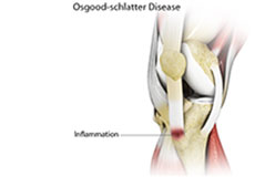 Osgood-Schlatter Disease