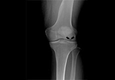 Osteonecrosis of the Knee