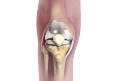 Patient Specific Knee Replacement