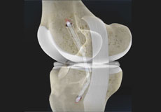 Posterior Cruciate Ligament (PCL) Injuries