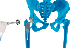 Robotic Assisted Hip Replacement