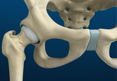 Stress Fractures of the Hip